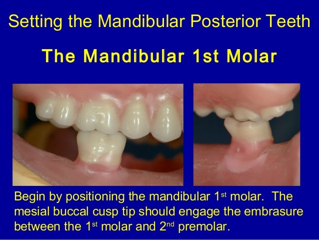 teeth setting