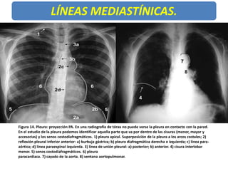 LÍNEAS MEDIASTÍNICAS.
Figura 14. Pleura: proyección PA. En una radiografía de tórax no puede verse la pleura en contacto c...