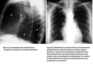 Figura 23. Compartimentos mediastínicos:
1) superior; 2) anterior; 3) medio; 4) posterior
Figura 24. Mediastino en proyecc...