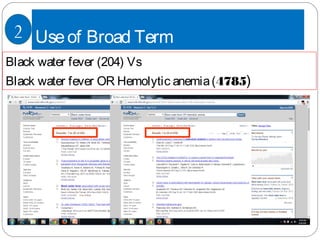 Useof Broad Term
Black water fever (204) Vs
Black water fever OR Hemolytic anemia(4785)
2
 