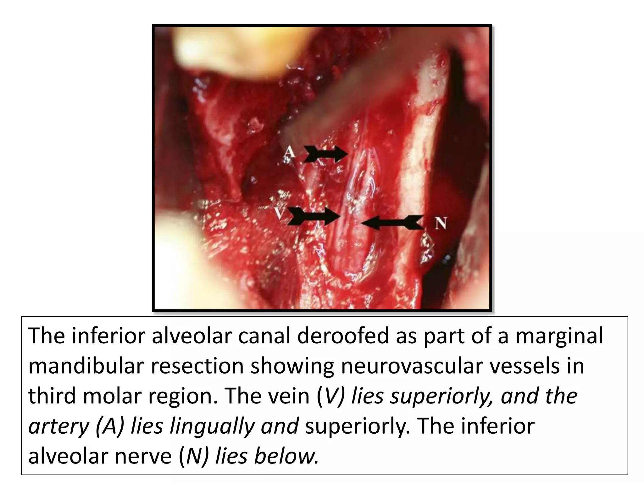 The inferior alveolar canal deroofed as part of a marginal
mandibular resection showing neurovascular vessels in
third molar region. The vein (V) lies superiorly, and the
artery (A) lies lingually and superiorly. The inferior
alveolar nerve (N) lies below.
 