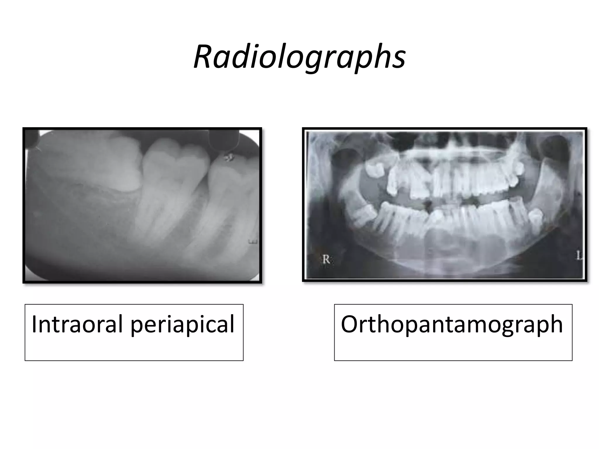 Radiolographs
OrthopantamographIntraoral periapical
 
