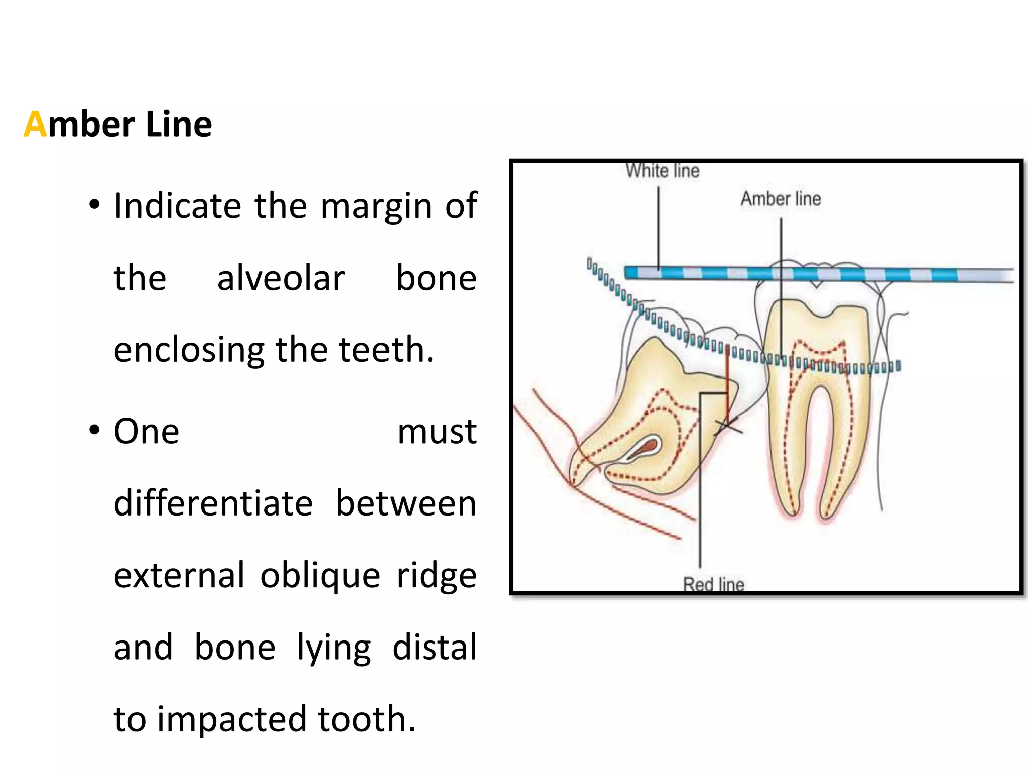 Amber Line
• Indicate the margin of
the alveolar bone
enclosing the teeth.
• One must
differentiate between
external oblique ridge
and bone lying distal
to impacted tooth.
 