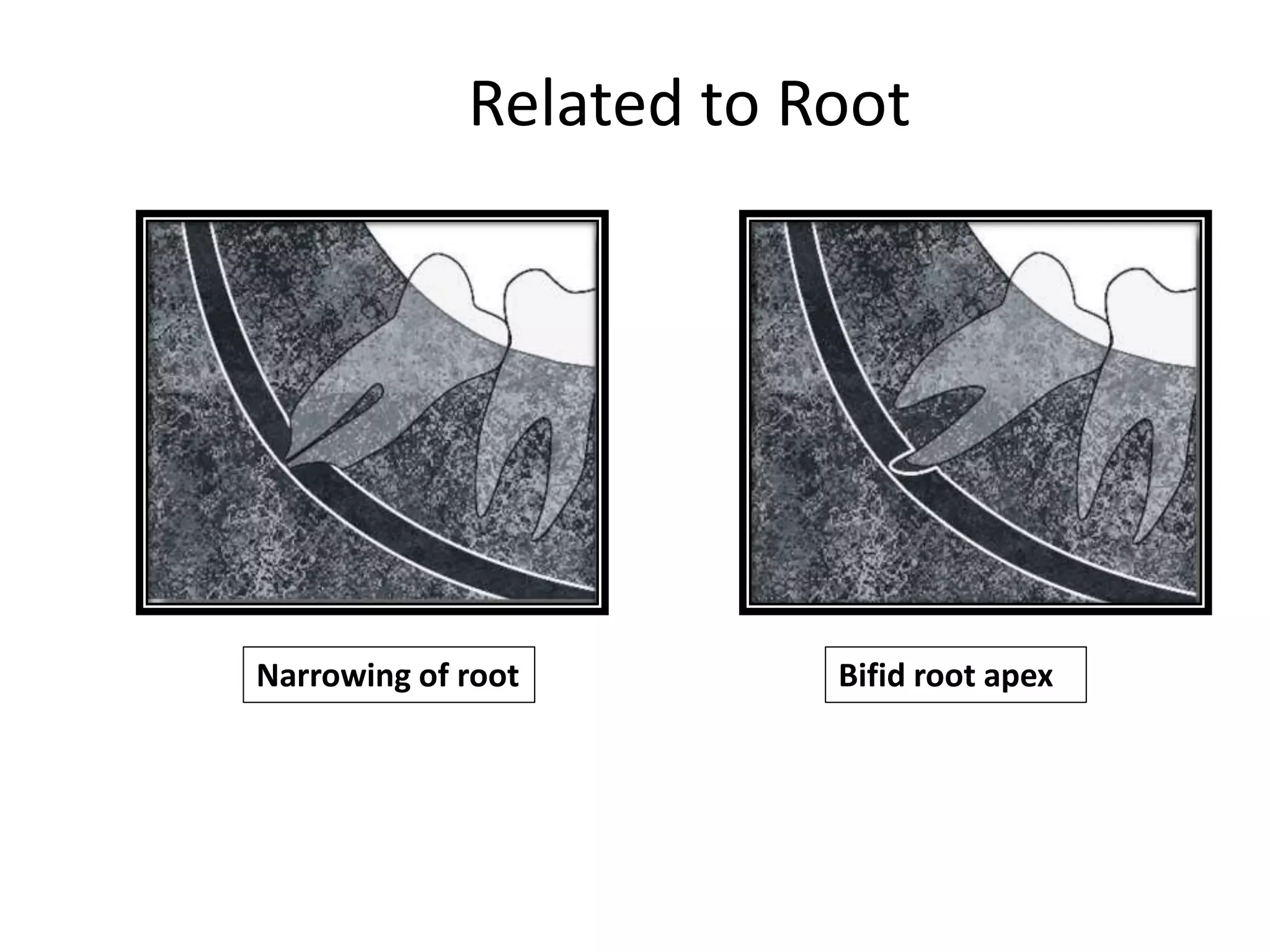 Narrowing of root Bifid root apex
Related to Root
 