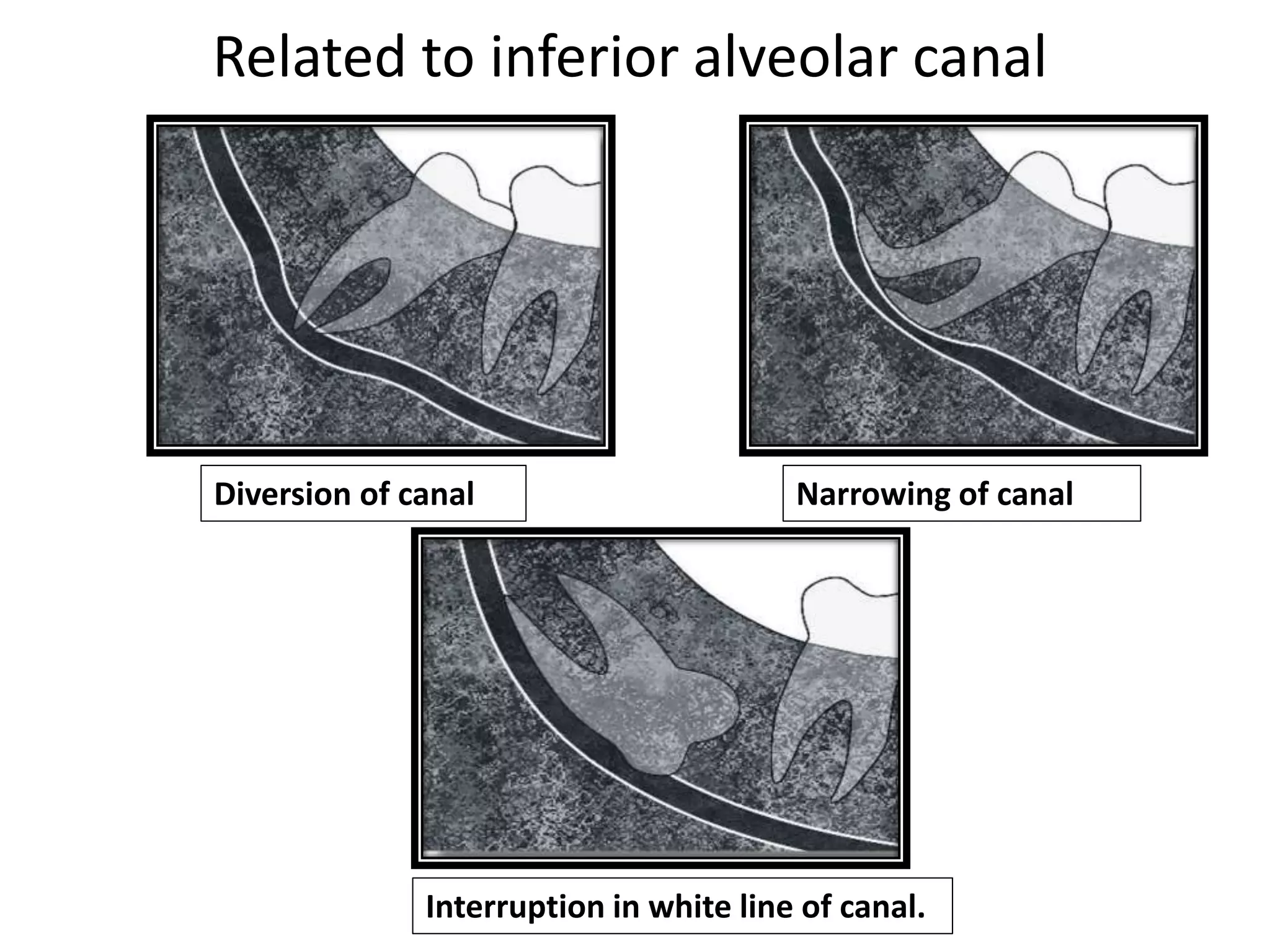 Diversion of canal
Interruption in white line of canal.
Narrowing of canal
Related to inferior alveolar canal
 