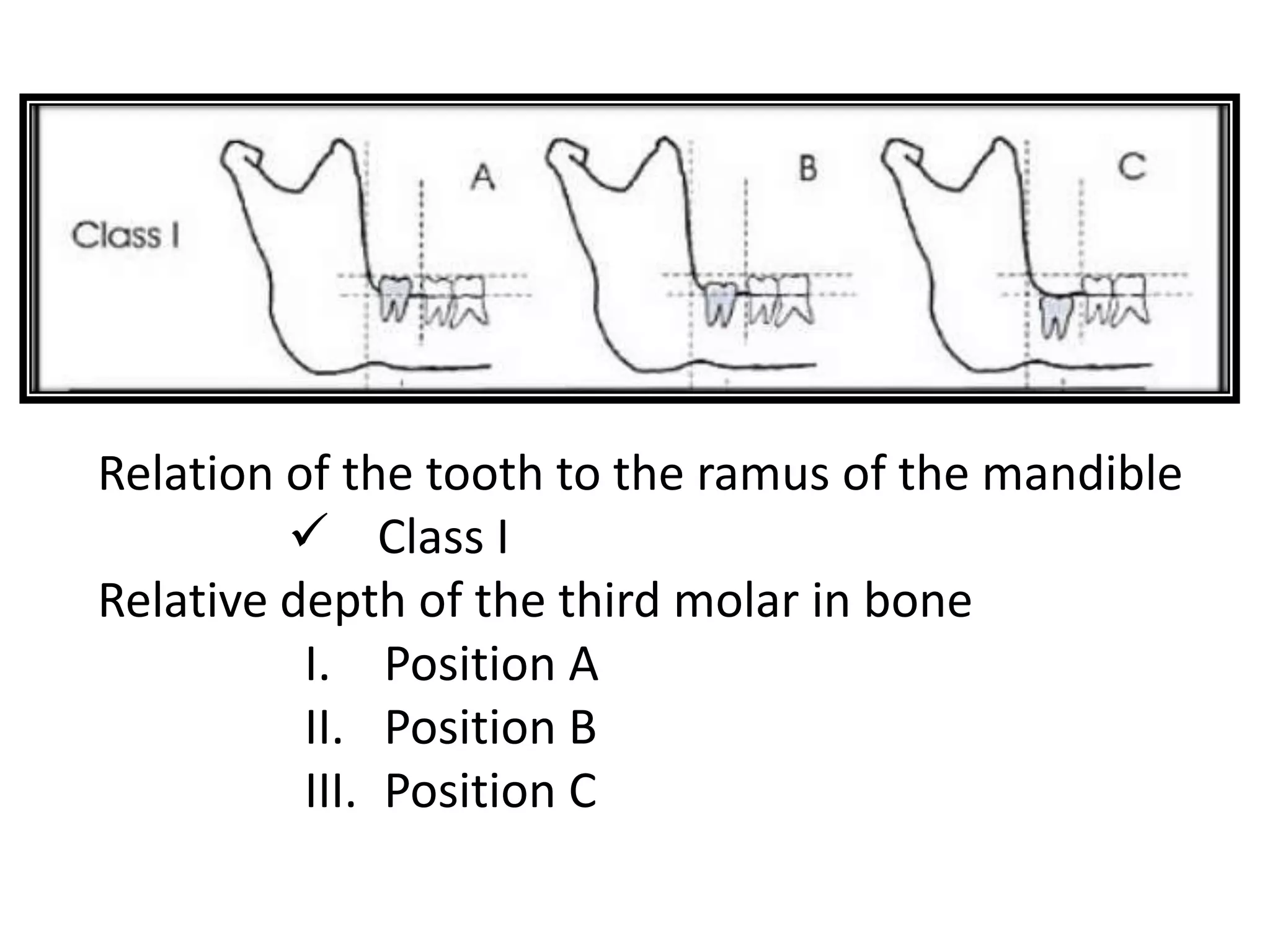 Relation of the tooth to the ramus of the mandible
 Class I
Relative depth of the third molar in bone
I. Position A
II. Position B
III. Position C
 