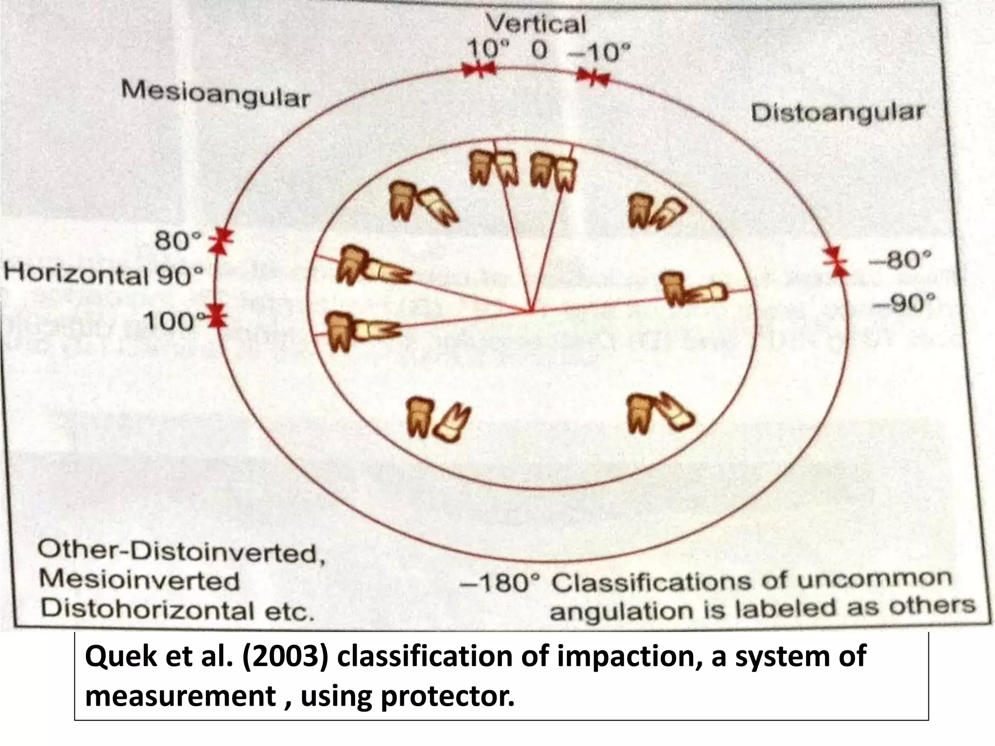Quek et al. (2003) classification of impaction, a system of
measurement , using protector.
 