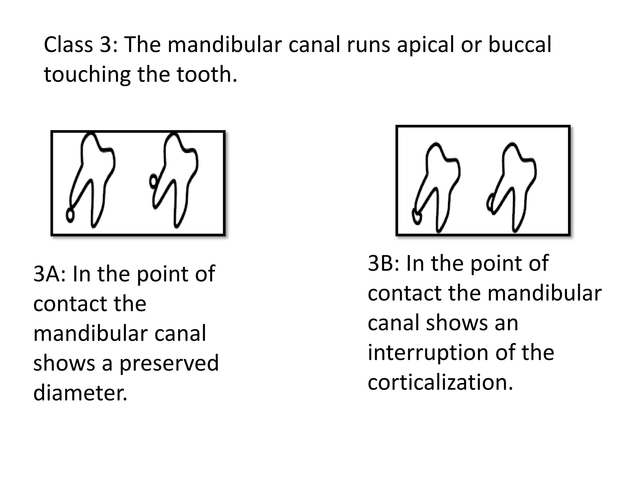 Class 3: The mandibular canal runs apical or buccal
touching the tooth.
3A: In the point of
contact the
mandibular canal
shows a preserved
diameter.
3B: In the point of
contact the mandibular
canal shows an
interruption of the
corticalization.
 
