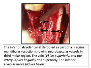 The inferior alveolar canal deroofed as part of a marginal
mandibular resection showing neurovascular vessels in
third molar region. The vein (V) lies superiorly, and the
artery (A) lies lingually and superiorly. The inferior
alveolar nerve (N) lies below.
 