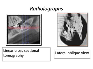 Radiolographs
Linear cross sectional
tomography
Lateral oblique view
 
