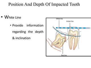 Position And Depth Of Impacted Tooth
• White Line
• Provide information
regarding the depth
& inclination
 
