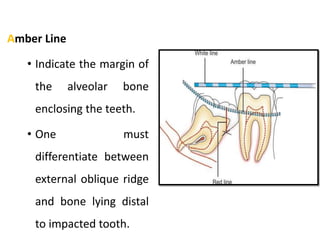Amber Line
• Indicate the margin of
the alveolar bone
enclosing the teeth.
• One must
differentiate between
external oblique ridge
and bone lying distal
to impacted tooth.
 
