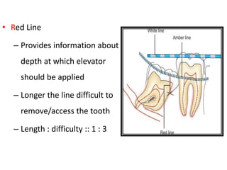 • Red Line
– Provides information about
depth at which elevator
should be applied
– Longer the line difficult to
remove/access the tooth
– Length : difficulty :: 1 : 3
 