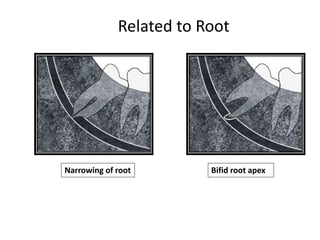 Narrowing of root Bifid root apex
Related to Root
 