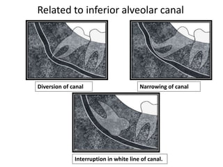 Diversion of canal
Interruption in white line of canal.
Narrowing of canal
Related to inferior alveolar canal
 