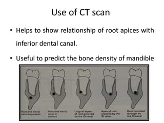Use of CT scan
• Helps to show relationship of root apices with
inferior dental canal.
• Useful to predict the bone density of mandible
 