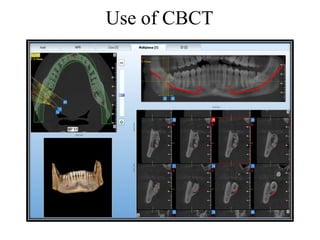 Use of CBCT
 