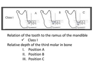 Relation of the tooth to the ramus of the mandible
 Class I
Relative depth of the third molar in bone
I. Position A
II. Position B
III. Position C
 