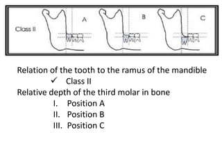 Relation of the tooth to the ramus of the mandible
 Class II
Relative depth of the third molar in bone
I. Position A
II. Position B
III. Position C
 