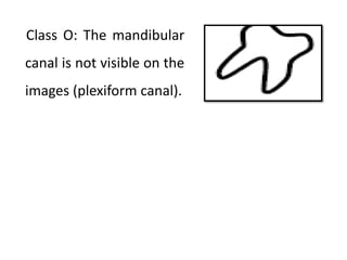 Class O: The mandibular
canal is not visible on the
images (plexiform canal).
 