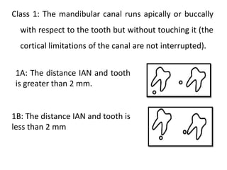 Class 1: The mandibular canal runs apically or buccally
with respect to the tooth but without touching it (the
cortical limitations of the canal are not interrupted).
1A: The distance IAN and tooth
is greater than 2 mm.
1B: The distance IAN and tooth is
less than 2 mm
 