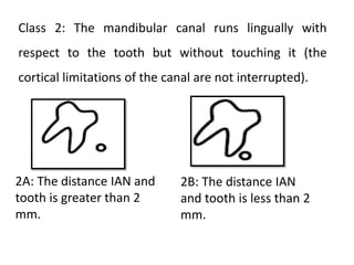 Class 2: The mandibular canal runs lingually with
respect to the tooth but without touching it (the
cortical limitations of the canal are not interrupted).
2B: The distance IAN
and tooth is less than 2
mm.
2A: The distance IAN and
tooth is greater than 2
mm.
 