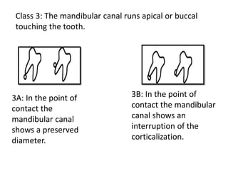 Class 3: The mandibular canal runs apical or buccal
touching the tooth.
3A: In the point of
contact the
mandibular canal
shows a preserved
diameter.
3B: In the point of
contact the mandibular
canal shows an
interruption of the
corticalization.
 