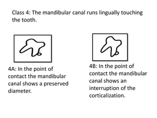 Class 4: The mandibular canal runs lingually touching
the tooth.
4A: In the point of
contact the mandibular
canal shows a preserved
diameter.
4B: In the point of
contact the mandibular
canal shows an
interruption of the
corticalization.
 