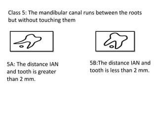 Class 5: The mandibular canal runs between the roots
but without touching them
5A: The distance IAN
and tooth is greater
than 2 mm.
5B:The distance IAN and
tooth is less than 2 mm.
 