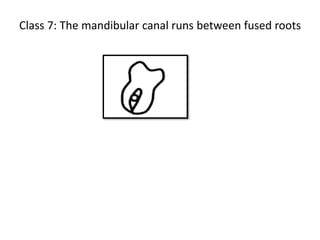 Class 7: The mandibular canal runs between fused roots
 
