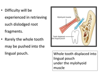 • Difficulty will be
experienced in retrieving
such dislodged root
fragments.
• Rarely the whole tooth
may be pushed into the
lingual pouch. Whole tooth displaced into
lingual pouch
under the mylohyoid
muscle
 