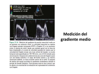 Medición del
gradiente medio
 