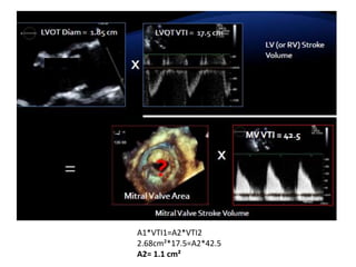 A1*VTI1=A2*VTI2
2.68cm²*17.5=A2*42.5
A2= 1.1 cm²
 