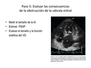 Paso 5: Evaluar las consecuencias
de la obstrucción de la válvula mitral
• Medir el tamaño de la AI
• Estimar PSAP
• Evaluar el tamaño y la función
sistólica del VD.
 