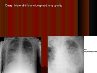 Diffuse Opacity 10.RESPIRATORY DISTRESS SYNDROME | PPT