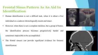 SEX DETERMINATION IN DENTISTRY | PPTX
