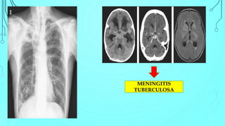 MENINGITIS
TUBERCULOSA
 