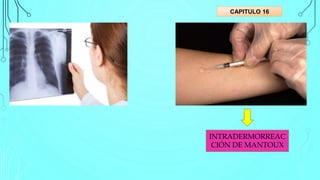 CAPITULO 16
INTRADERMORREAC
CIÓN DE MANTOUX
 