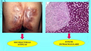 AVIUM-
INTRACELLULARE
MICOBACTERIAS
ATÍPICAS
 