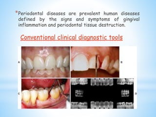 Conventional clinical diagnostic tools
*Periodontal diseases are prevalent human diseases
defined by the signs and symptoms of gingival
inflammation and periodontal tissue destruction.
4
 