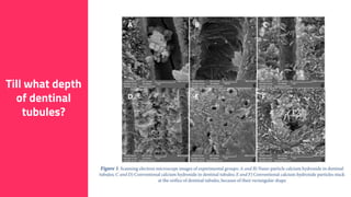 17
Electrophoretically activated Ca(OH)2 Lin et al. (2005)
 Significantly more effective up to depths of 200–500 µm
no viable bacteria in dentinal tubules to a depth of 500 µm
from the root canal space within 7 days.
Till what depth
of dentinal
tubules?
Zand V, Mokhtari H, Hasani A, Jabbari G. Comparison of the penetration
depth of conventional and nano-particle calcium hydroxide into dentinal
tubules. Iranian endodontic journal. 2017;12(3):366.
 