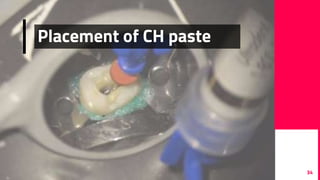 34
Placement of CH paste
 
