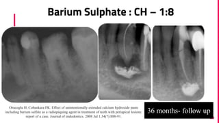 Barium Sulphate : CH – 1:8
50
36 months- follow up
Orucoglu H, Cobankara FK. Effect of unintentionally extruded calcium hydroxide paste
including barium sulfate as a radiopaquing agent in treatment of teeth with periapical lesions:
report of a case. Journal of endodontics. 2008 Jul 1;34(7):888-91.
 