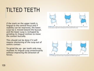 TILTED TEETH
if the mark on the upper tooth is
lingual to the central fossa and if
stability can be improved, the lower
cusp tip is moved toward the buccal,
and the lower cusp is reshaped by
grinding its lingual inclines to move
the contact buccally.
This should not be done if it will
require shortening of the cusp out of
centric contact .
To grind the up- per tooth only may
mutilate its lingual cusp unnecessarily
without improving the direction of
forces.
109
 