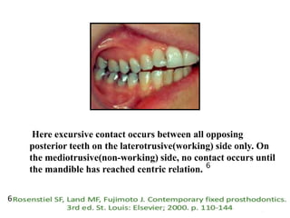 Here excursive contact occurs between all opposing
posterior teeth on the laterotrusive(working) side only. On
the mediotrusive(non-working) side, no contact occurs until
the mandible has reached centric relation.
24
6
6
 