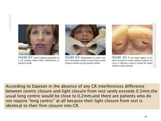 28
According to Dawson in the absence of any CR interferences difference
between centric closure and light closure from rest rarely exceeds 0.5mm,the
usual long centric would be close to 0.2mm,and there are patients who do
not require “long centric” at all because their light closure from rest is
identical to their firm closure into CR.
 