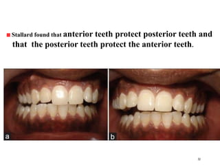 Stallard found that anterior teeth protect posterior teeth and
that the posterior teeth protect the anterior teeth.
32
 