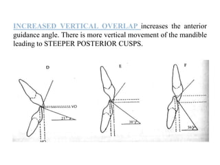 57
INCREASED VERTICAL OVERLAP increases the anterior
guidance angle. There is more vertical movement of the mandible
leading to STEEPER POSTERIOR CUSPS.
 