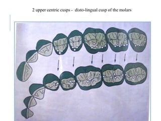 2 upper centric cusps - disto-lingual cusp of the molars
72
 