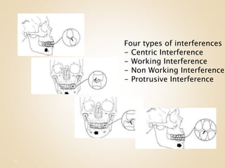 75
Four types of interferences
- Centric Interference
- Working Interference
- Non Working Interference
- Protrusive Interference
 